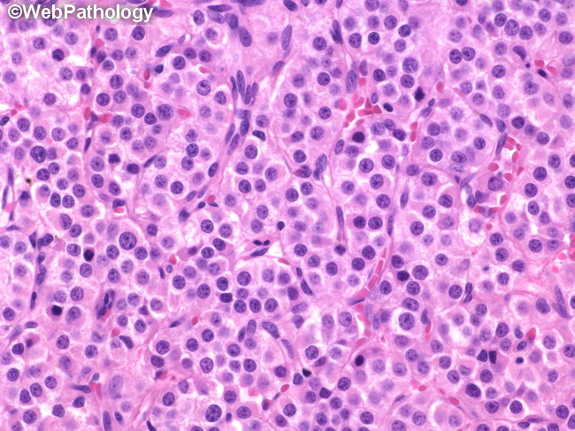 Leydig Cell Tumor.jpg